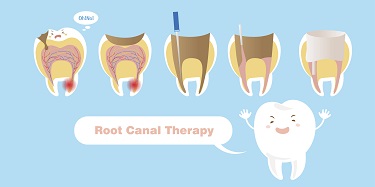 For comfortable general dental and root canal treatments using the latest technology, see the dentists at Parkside Dental in Dubbo.